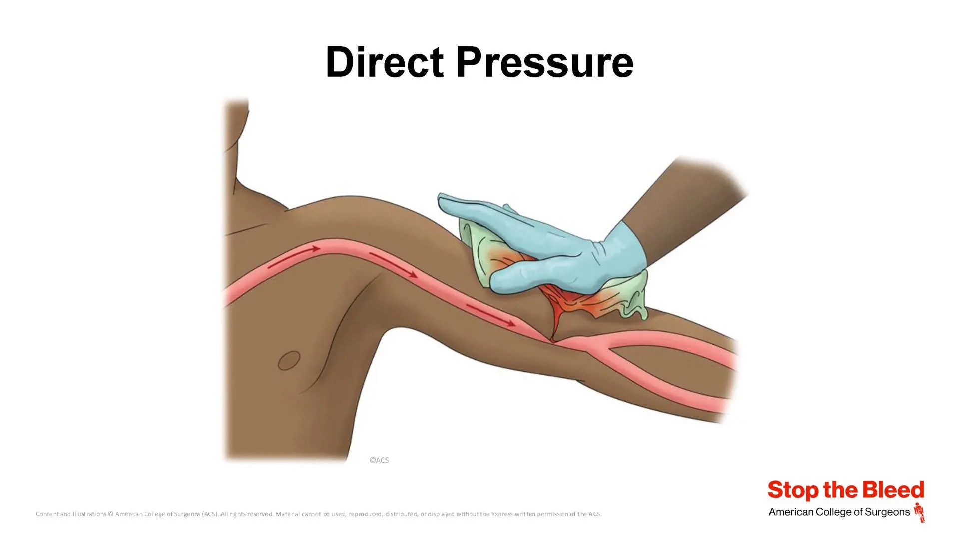 New ACS Stop the Bleed Course Launched