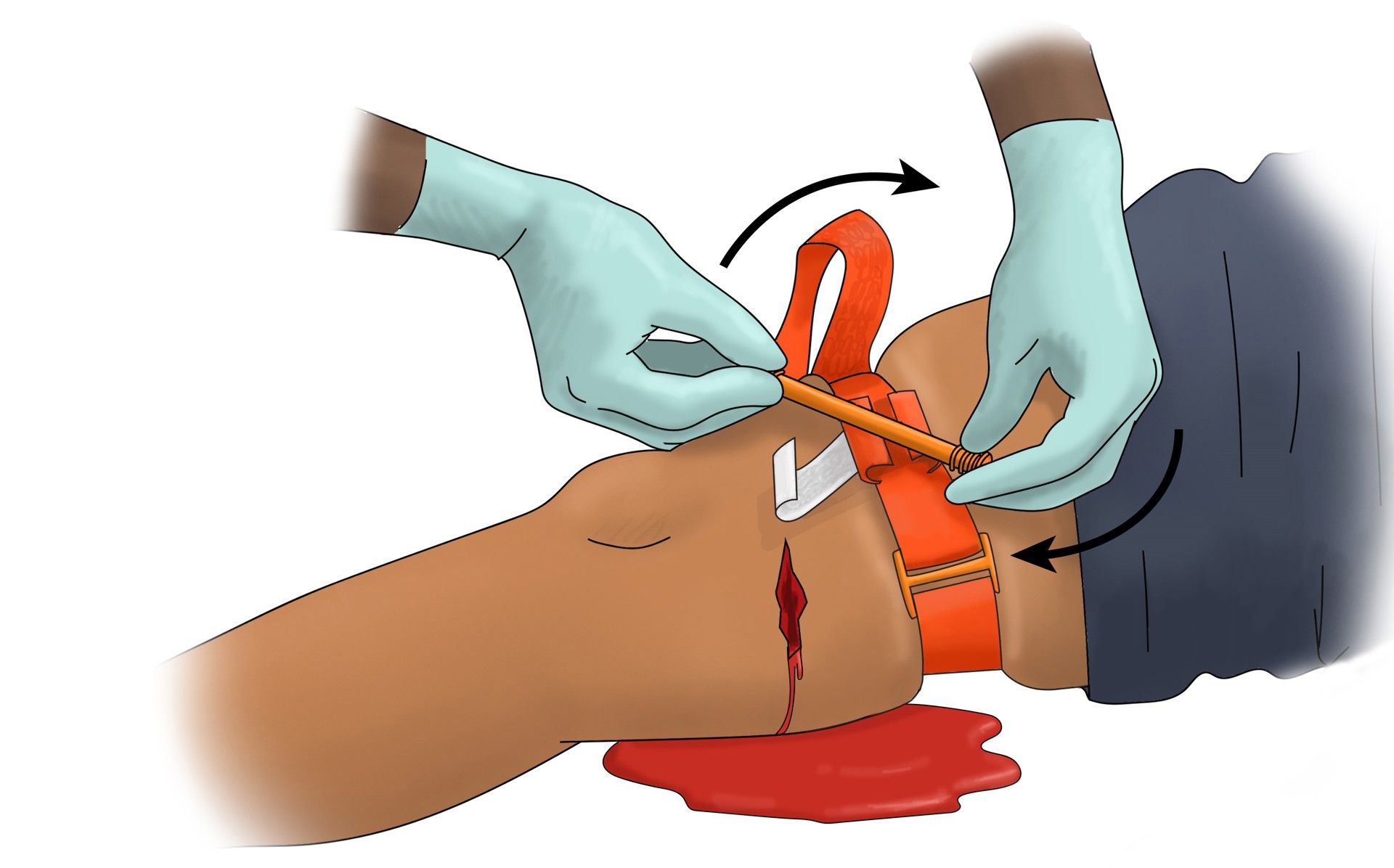 About ACS Stop the Bleed