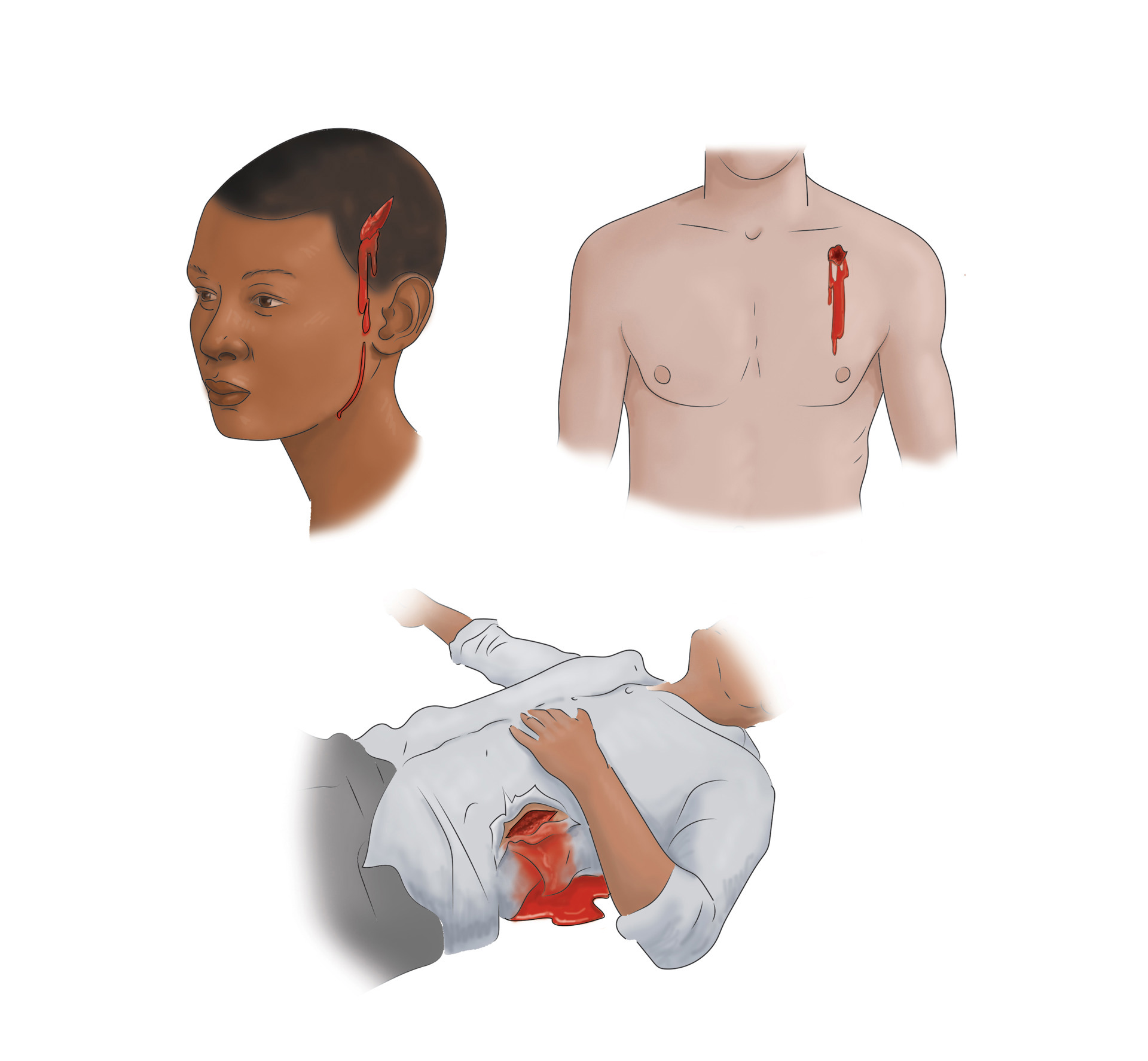 Stop the Bleed Month | ACS Stop the Bleed